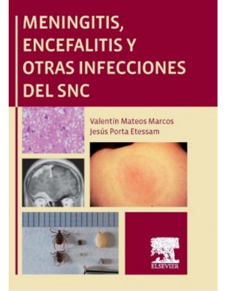 Meningitis, encefalitis y otras infecciones del snc