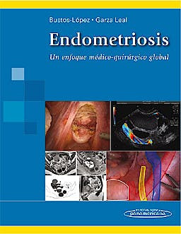 Endometriosis. Un Enfoque Médico-Quirúrgico Global